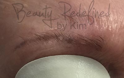 Before Tattoo Removal